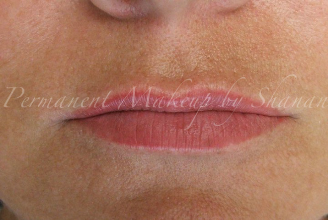 vh healed first session lips.01.jpg